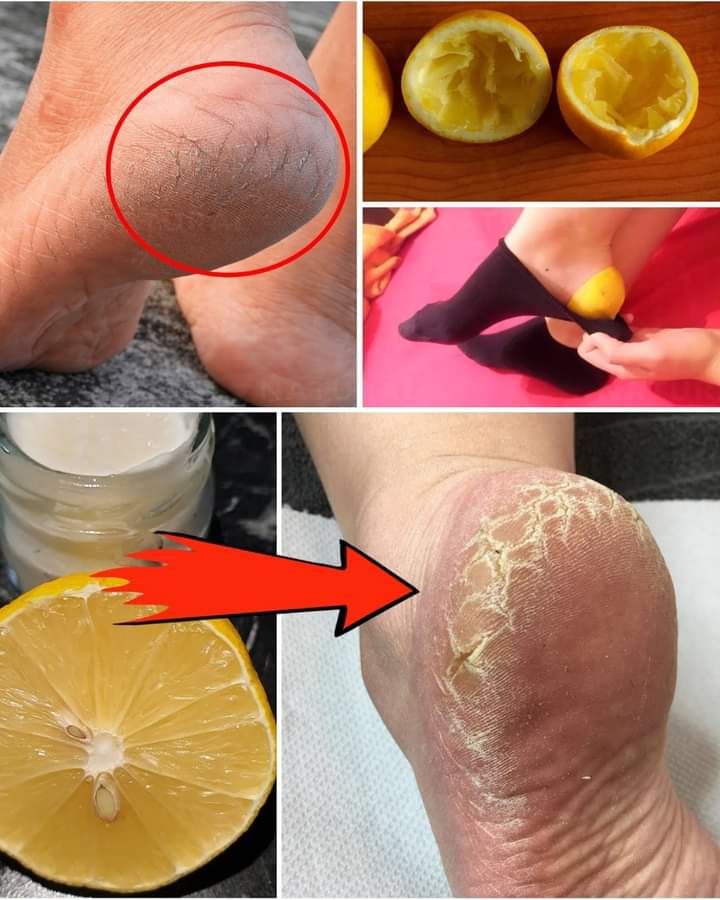 Cracked Heels: Unstoppable Grandma’s Cure